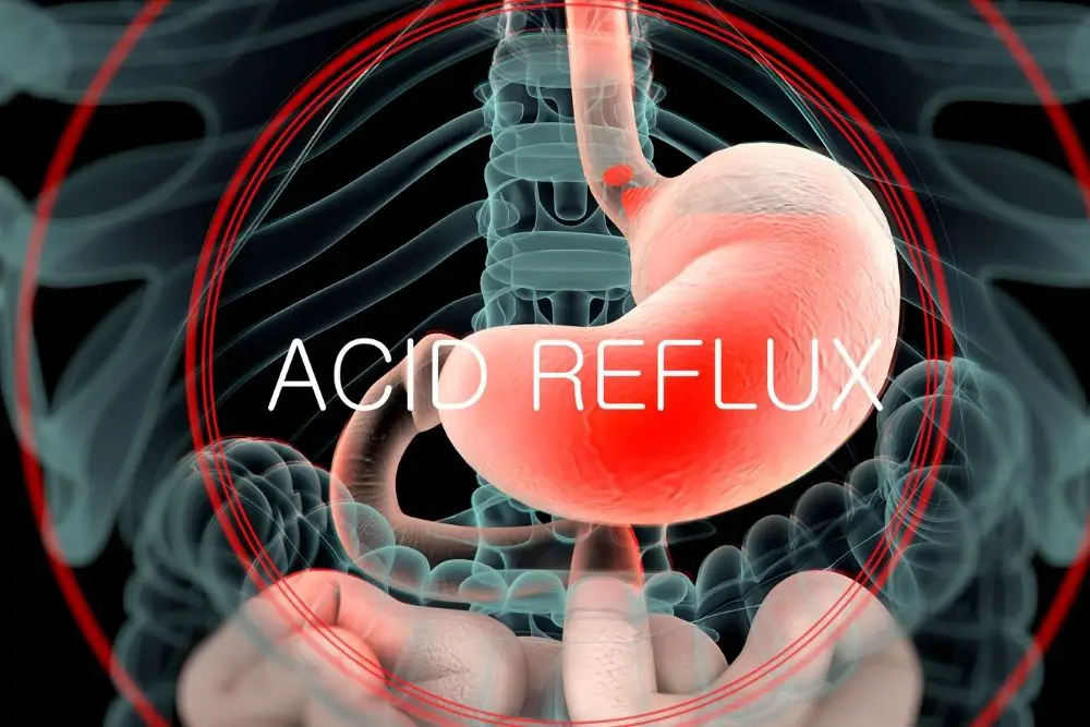 symptoms of acid reflux